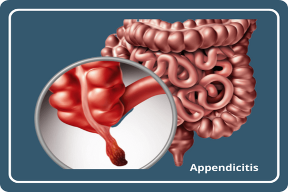 Appendix surgery