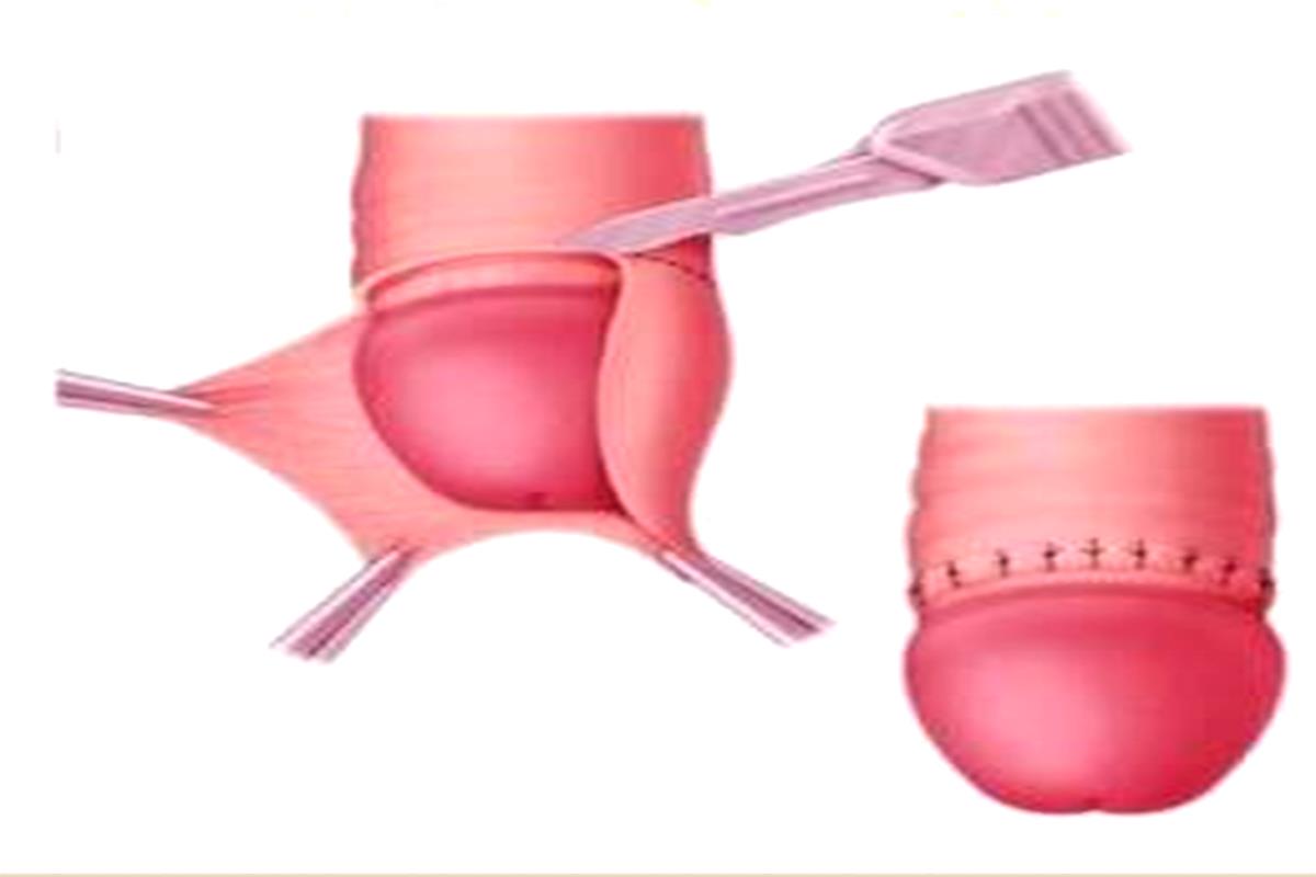 Tight Foreskin (phimosis)